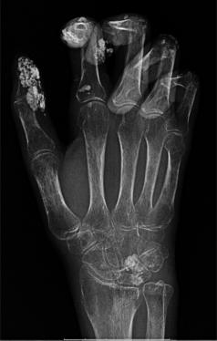 X-rays of Calcinosis of the hand and fingers in scleroderma.